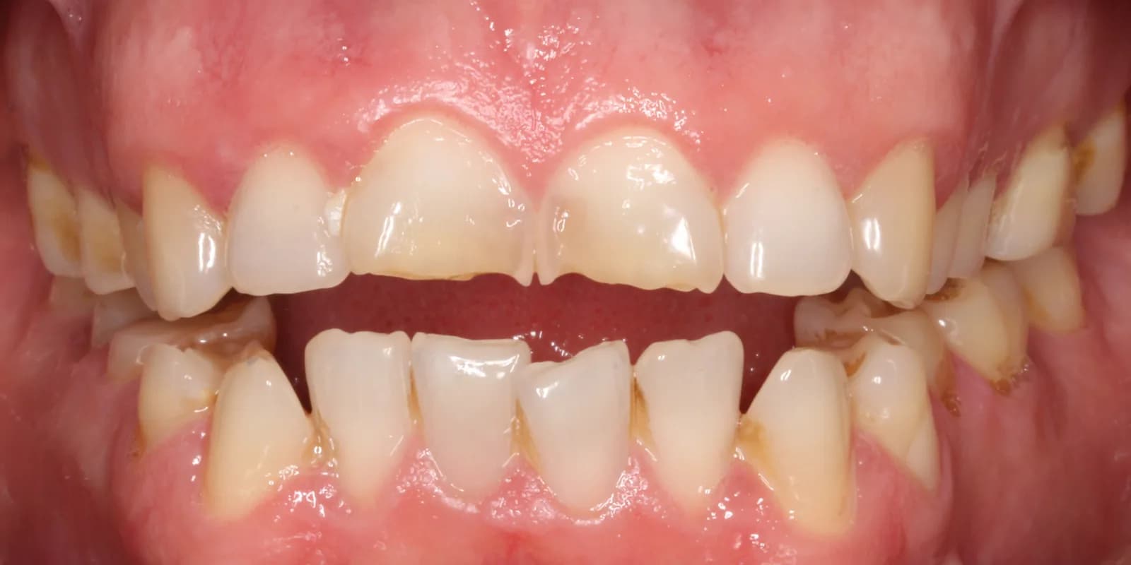 Rehabilitación de dientes desgastados: comparación de la sonrisa antes y después — antes