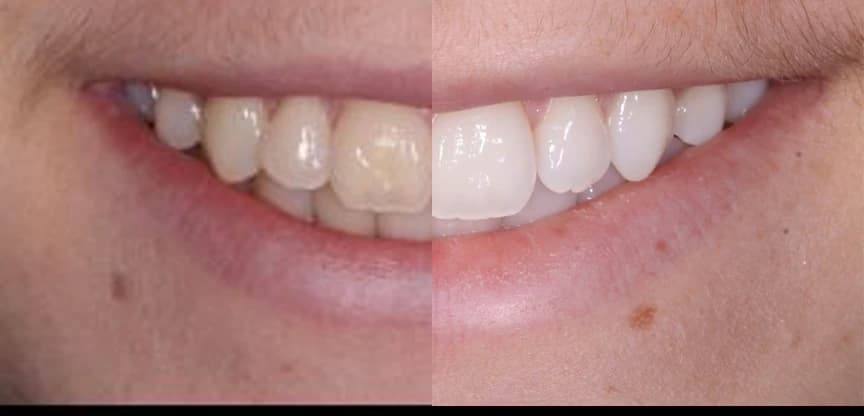 Antes y después de un blanqueamiento dental