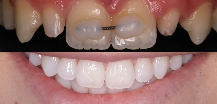 Antes y después de unas carillas dentales