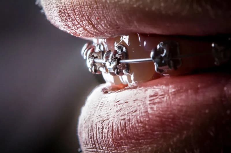 Brackets metálicos colocados