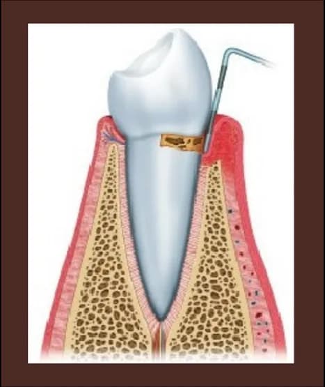 Ilustración de una encía con gingivitis