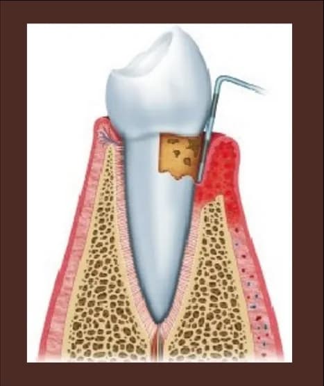 Ilustración de una encía con periodontitis