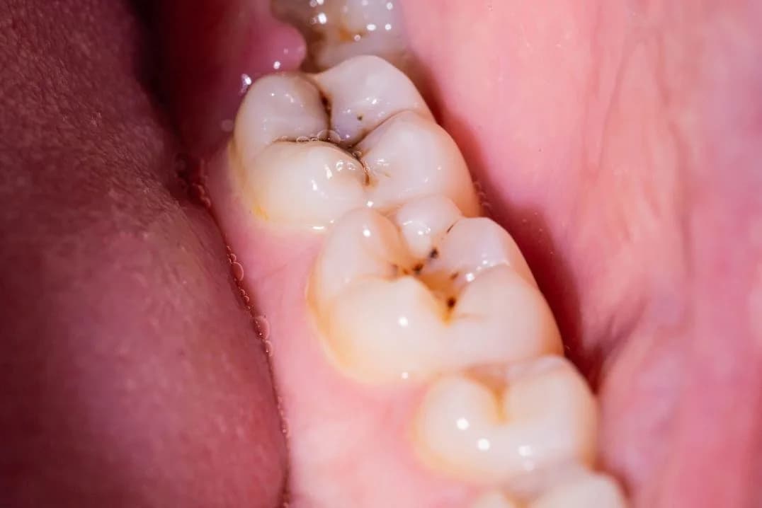 Caries en una muela antes del empaste