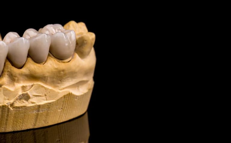 Prótesis fija de coronas y puentes sobre un modelo dental