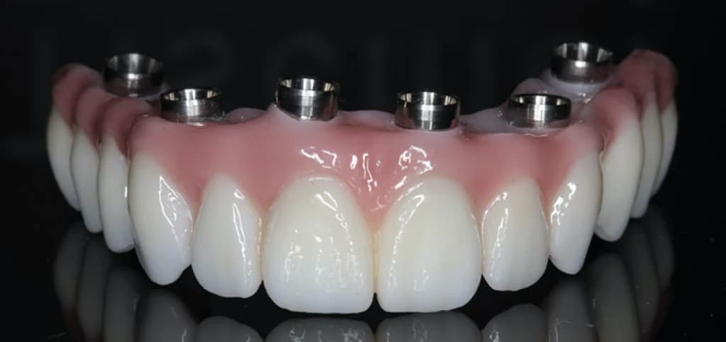 Rehabilitación oral completa sobre implantes