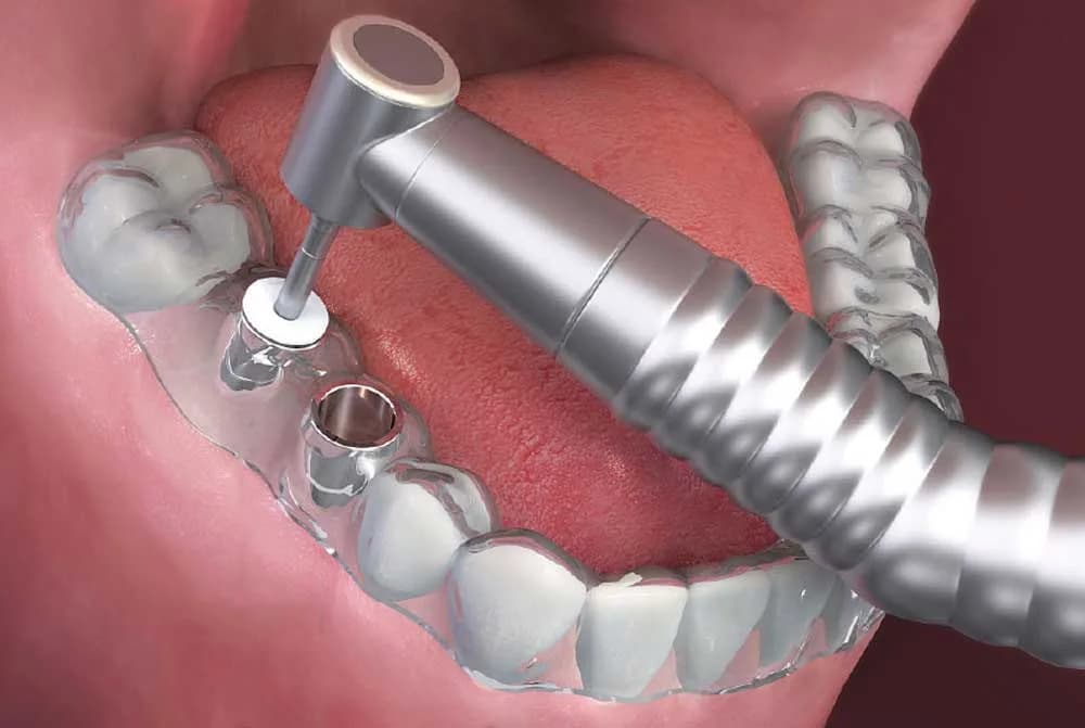 Férula quirúrgica para la colocación guiada de implantes