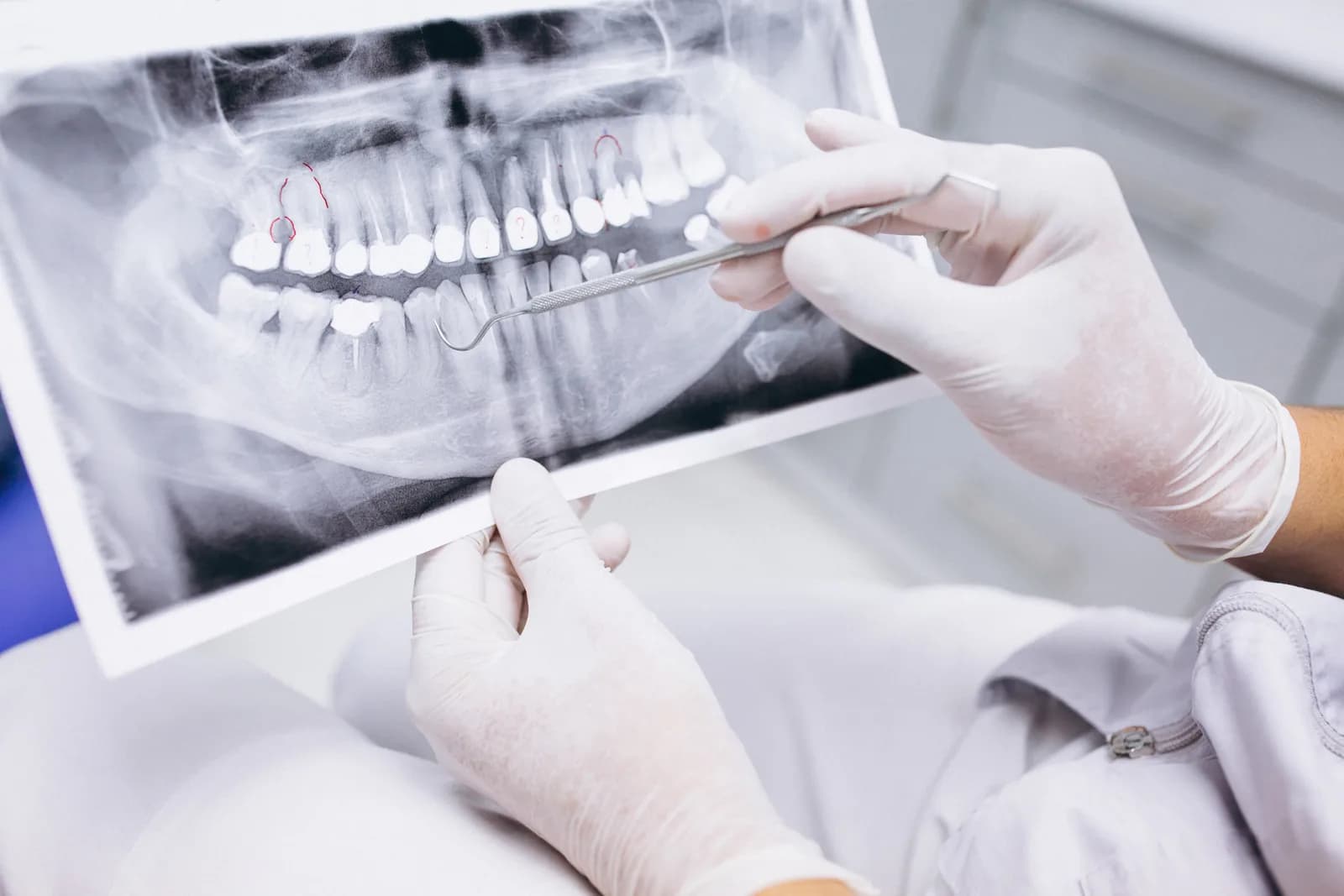 Radiografía panorámica para planificar la corona definitiva