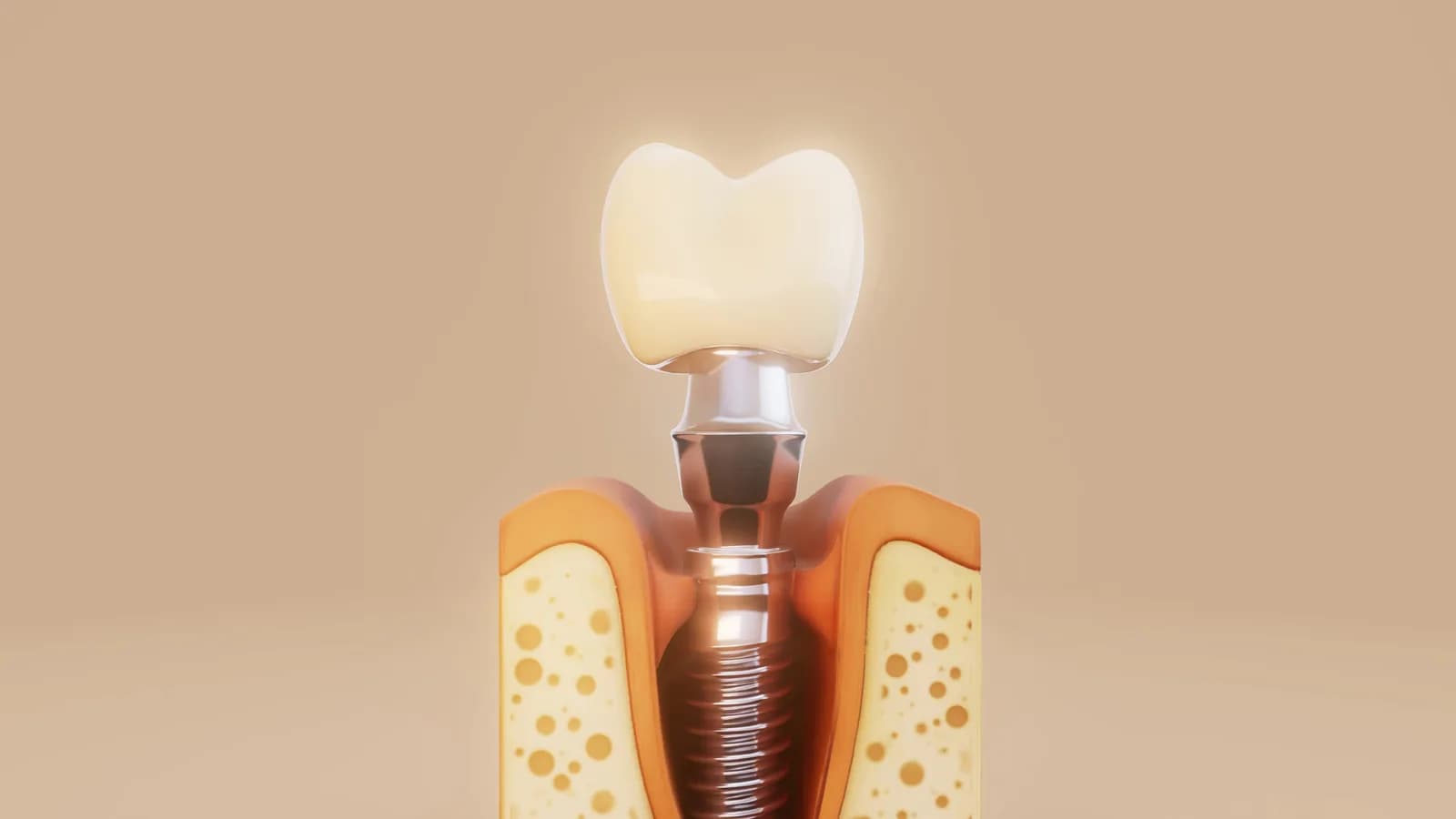 Ilustración de un implante dental con su corona