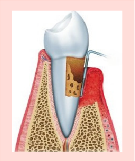 periodontitis-aguda
